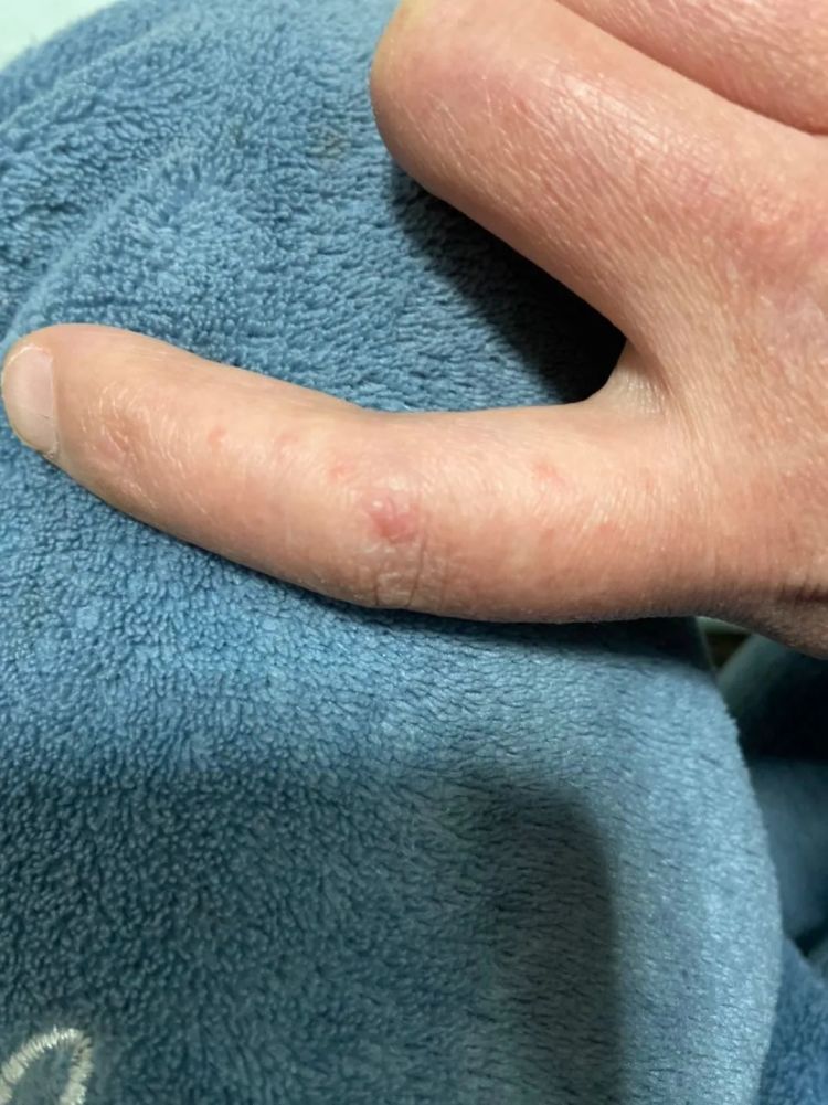 太崩溃!杭州网友:从头到脚长满冻疮,又肿又痒!医生提醒…… 太崩溃!杭州网友:从头到脚长满冻疮,又肿又痒!医生提醒……