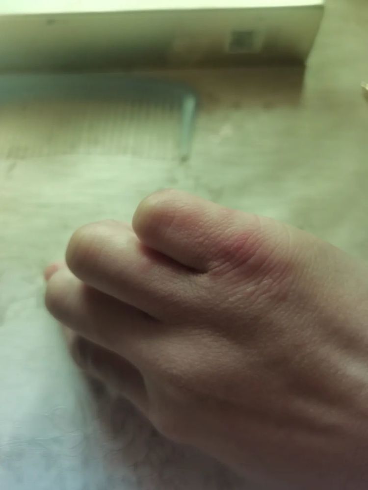 太崩溃!杭州网友:从头到脚长满冻疮,又肿又痒!医生提醒…… 太崩溃!杭州网友:从头到脚长满冻疮,又肿又痒!医生提醒……