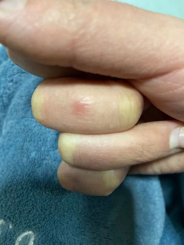 太崩溃!杭州网友:从头到脚长满冻疮,又肿又痒!医生提醒…… 太崩溃!杭州网友:从头到脚长满冻疮,又肿又痒!医生提醒……