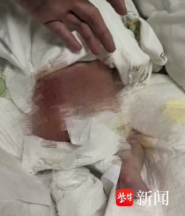 出生第二天被护士烫伤的宝宝病情稳定，家人第一次探望