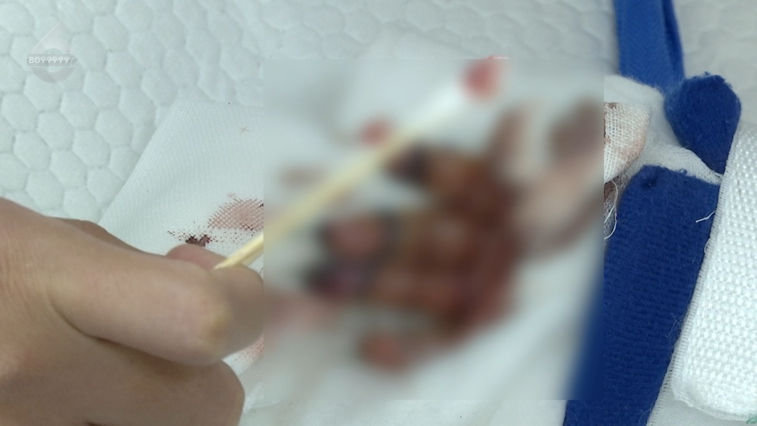 隔着屏幕都疼！1岁半女童玩这种东西，4根手指被切成7段