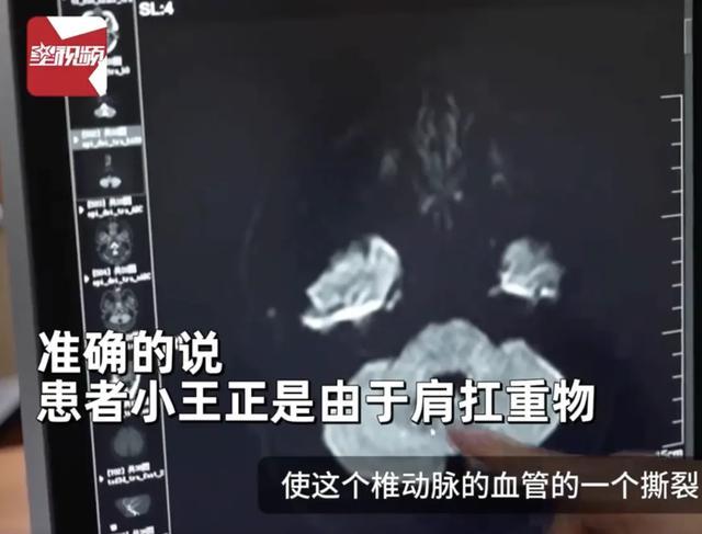 26岁小伙突发脑梗，居然跟身上背的包有关！医生紧急提醒