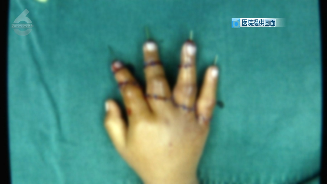 隔着屏幕都疼！1岁半女童玩这种东西，4根手指被切成7段