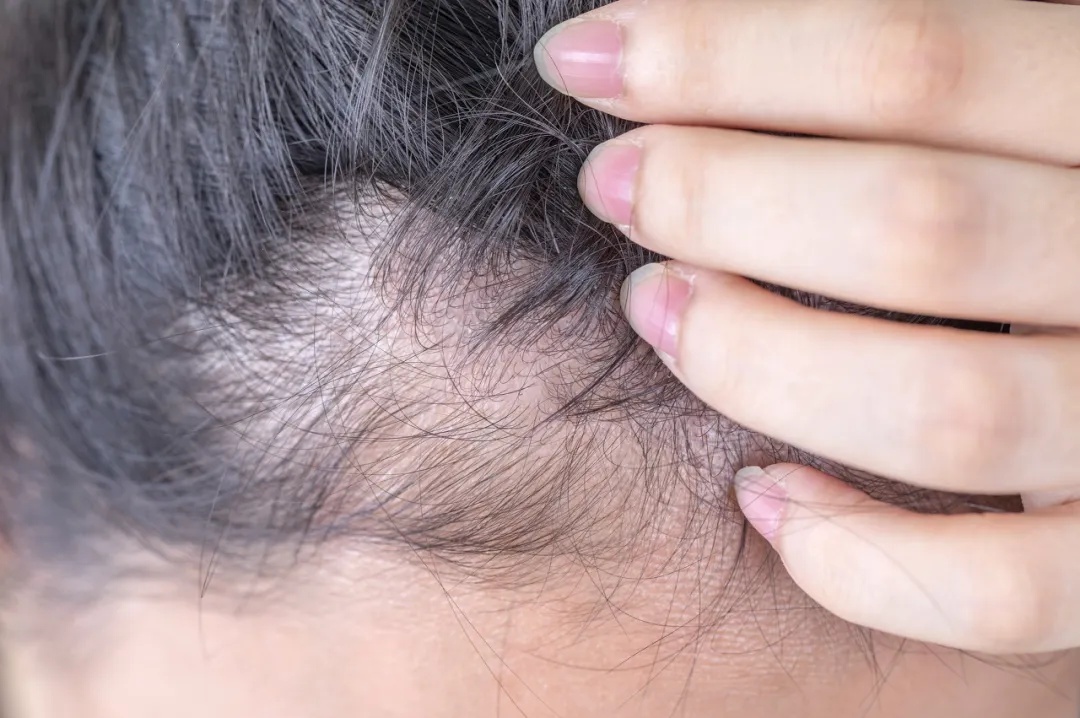 发缝越来越宽,怎么办?这种情况要赶紧治疗 发缝越来越宽,怎么办?这种情况要赶紧治疗