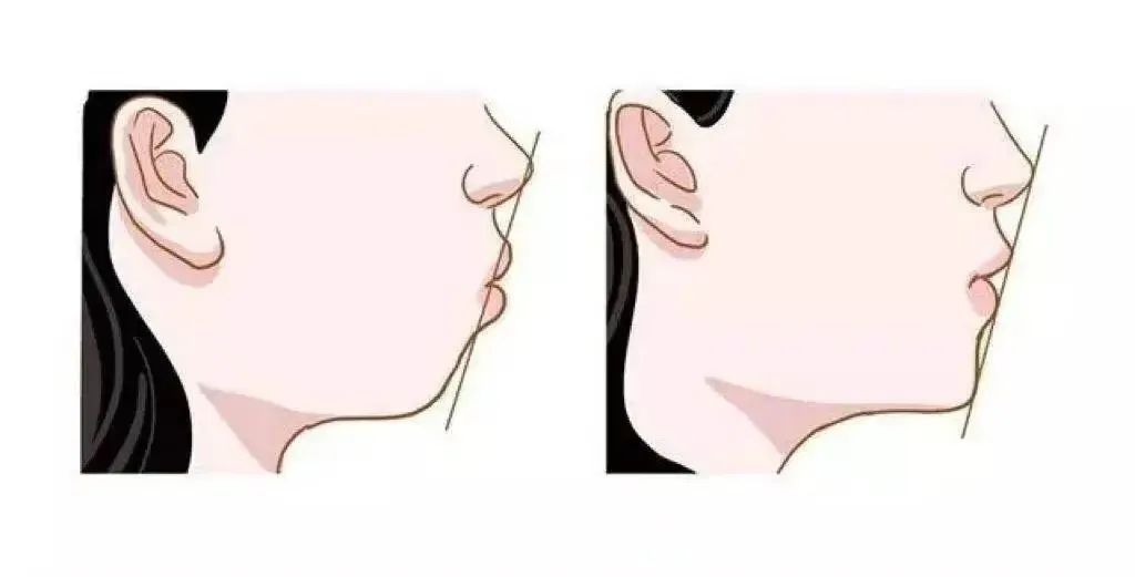 田亮最新回应:正在矫正!这个病很常见,4个年龄很关键 田亮最新回应:正在矫正!这个病很常见,4个年龄很关键