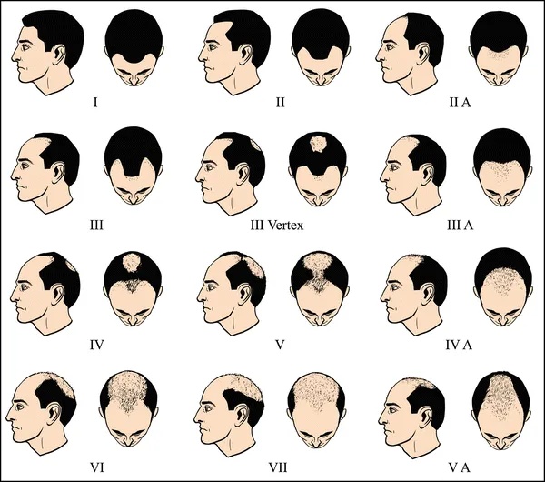 发缝越来越宽,怎么办?这种情况要赶紧治疗 发缝越来越宽,怎么办?这种情况要赶紧治疗