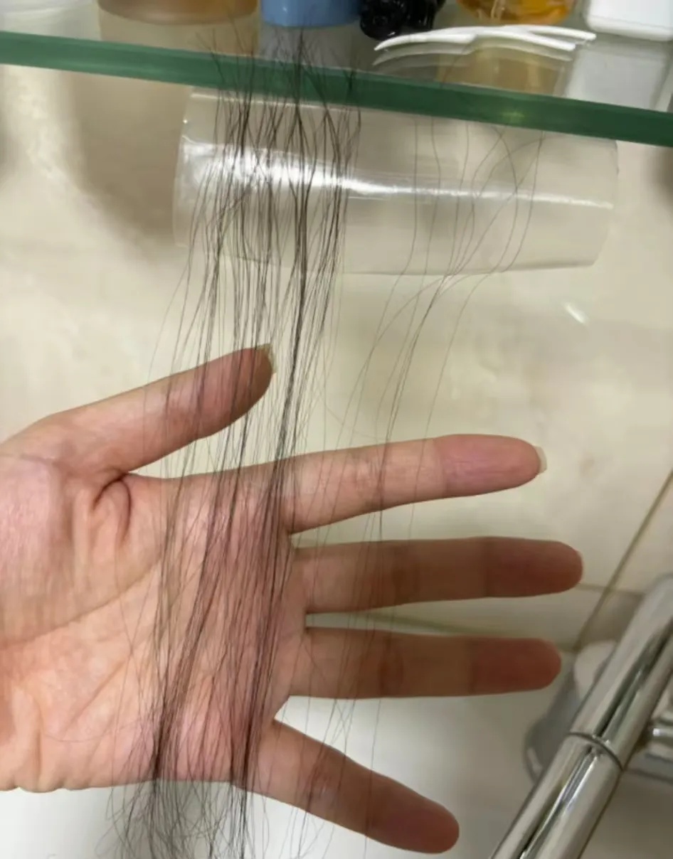 发缝越来越宽,怎么办?这种情况要赶紧治疗 发缝越来越宽,怎么办?这种情况要赶紧治疗