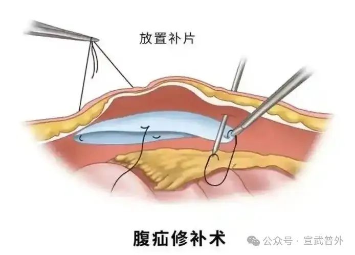 勿以“疝”小而不为