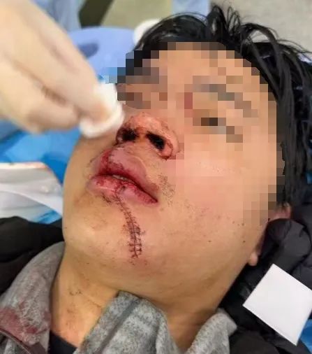 高速停车查导航?一乘客牙被撞掉! 高速停车查导航?一乘客牙被撞掉!