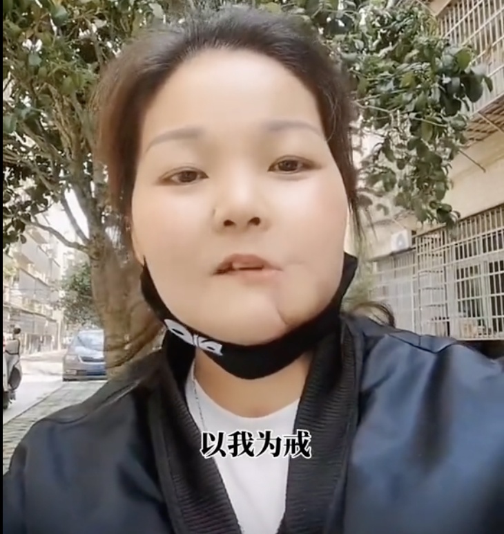 她已离世,年仅42岁!曾手术割去半张脸 她已离世,年仅42岁!曾手术割去半张脸