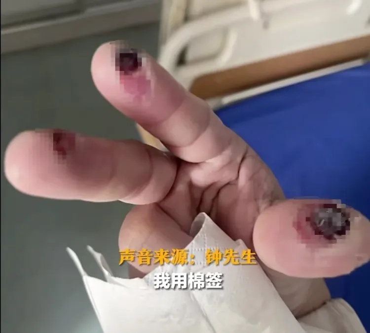 警惕！男子工作时用手拿棉签触碰氢氟酸，三根手指“烂出黑洞”