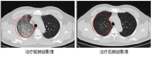 警惕！发现一例罕见传染病“Q热”！在极端环境中可保持长达几个月的感染性