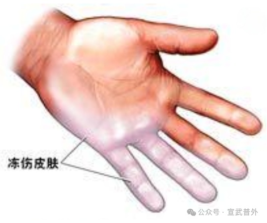 冻伤:正常处理,“急”时挺住 冻伤:正常处理,“急”时挺住
