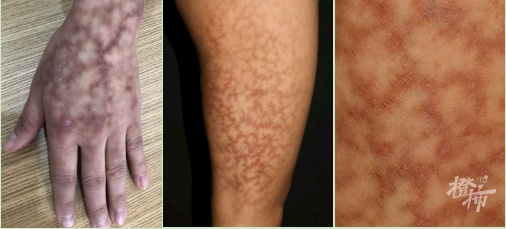 睡前一个动作，她手脚突现“蟒蛇纹”！冬天极易忽视...