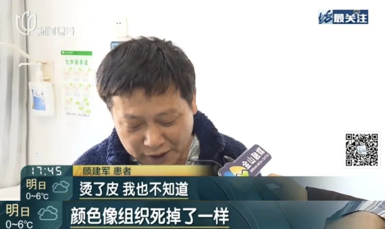 女子手脚突现“蟒蛇纹”!冬天极易忽视,医生提醒! 女子手脚突现“蟒蛇纹”!冬天极易忽视,医生提醒!