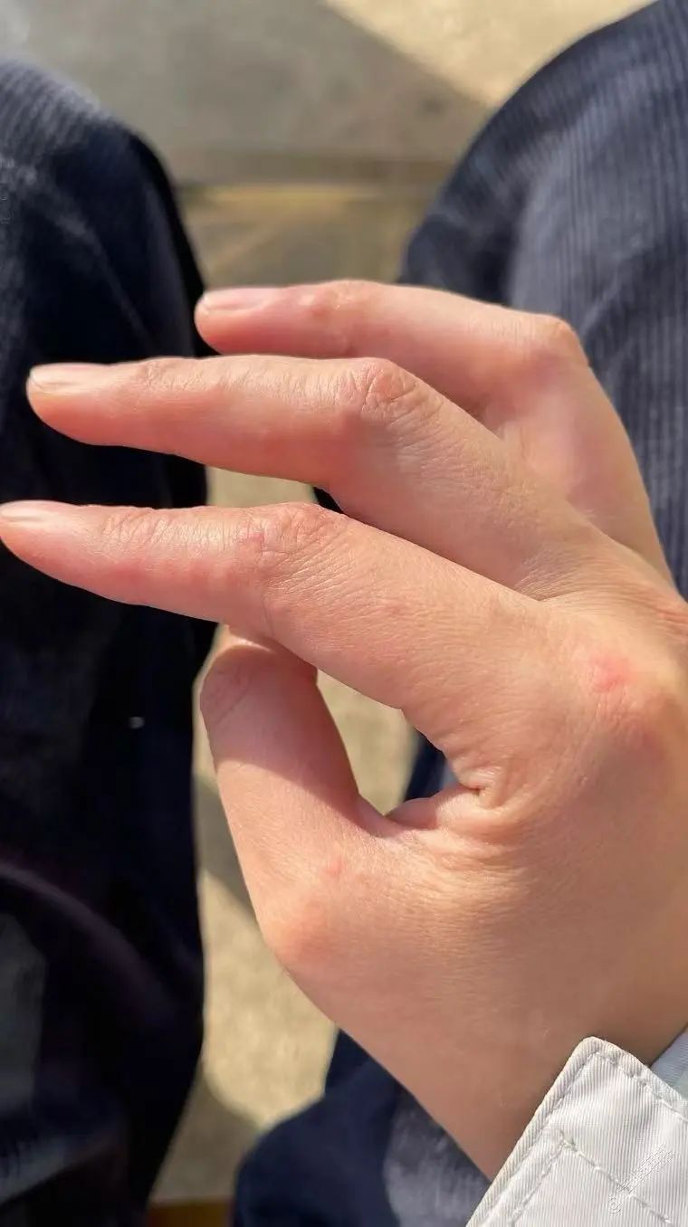-2℃！冷冷冷！最近好多重庆人又遭了，网友：又痛又痒，好难根治……