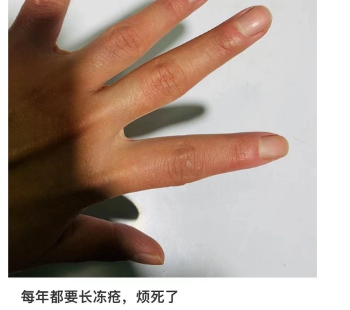 -2℃！冷冷冷！最近好多重庆人又遭了，网友：又痛又痒，好难根治……