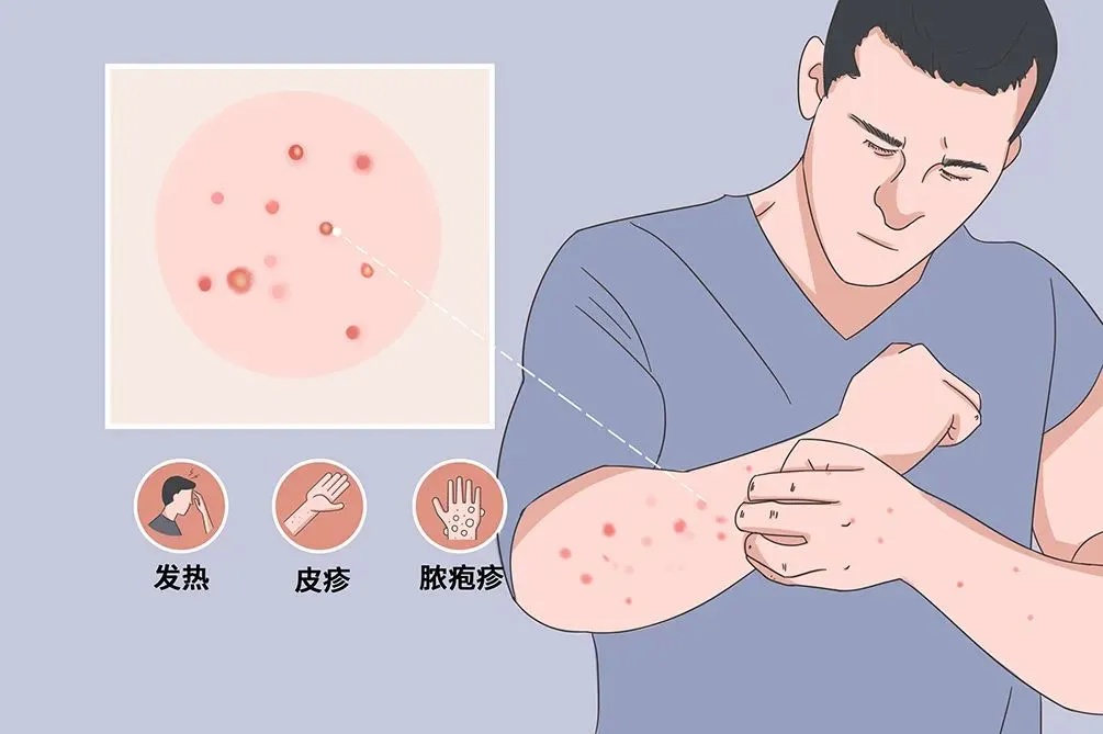4人“亲密接触后感染猴痘”,这次毒株有何特点?中疾控提醒→ 4人“亲密接触后感染猴痘”,这次毒株有何特点?中疾控提醒→