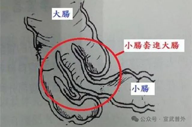 小儿肠套叠怎么办？