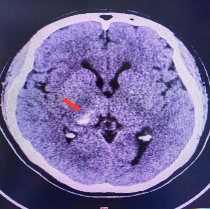 家长辅导孩子写作业，气到脑出血