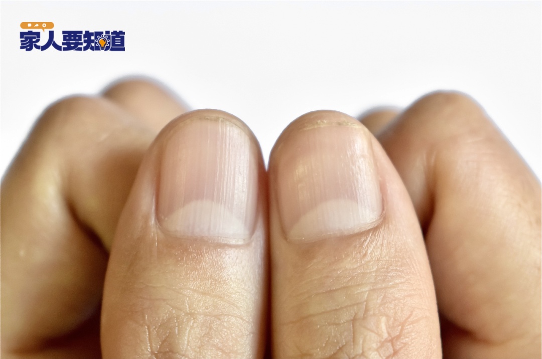 指甲起竖纹是肠胃不好？指甲“月牙”越多越健康？真相是……