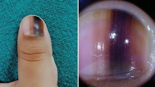 指甲起竖纹是肠胃不好？指甲“月牙”越多越健康？真相是……