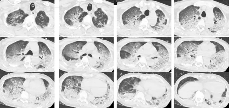 男子口吐白沫，一查两肺全白了，竟是因为这个习惯！冬天洗澡要注意