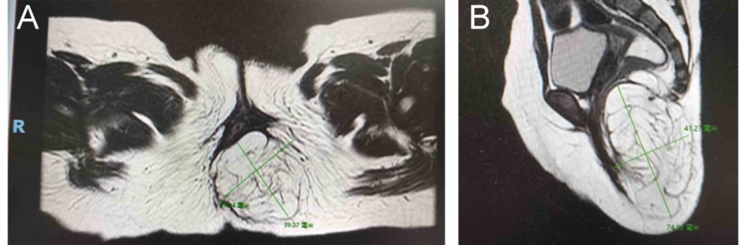 屁股长出肉“尾巴”，一查竟是肿瘤……