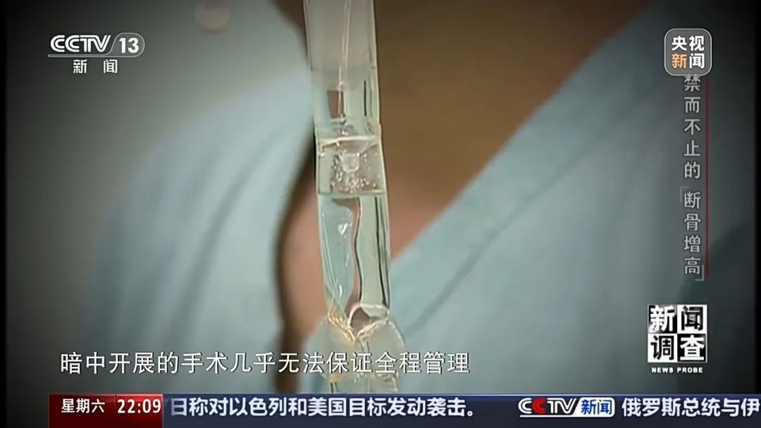 “腿喷脓了，挤也挤不完” ，女子出国做手术断骨增高6厘米，右腿严重感染