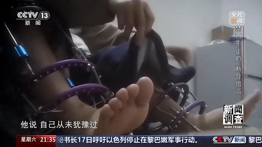 “腿喷脓了，挤也挤不完” ，女子出国做手术断骨增高6厘米，右腿严重感染