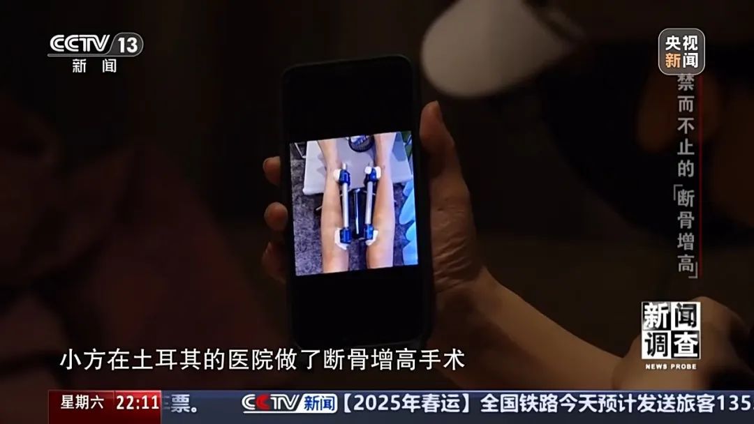 “腿喷脓了，挤也挤不完” ，女子出国做手术断骨增高6厘米，右腿严重感染