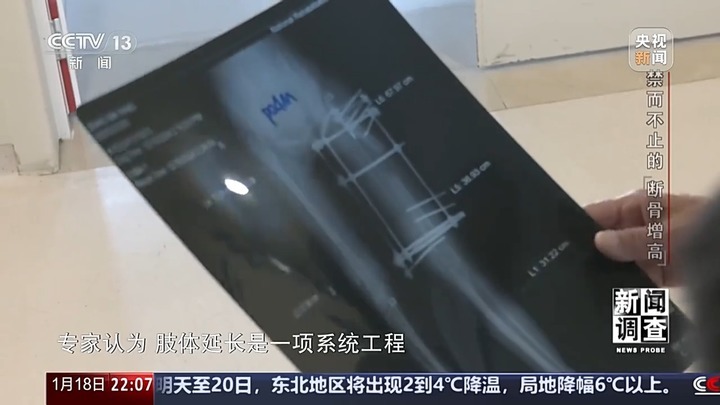 央视曝断骨增高灰色产业链 央视曝断骨增高灰色产业链