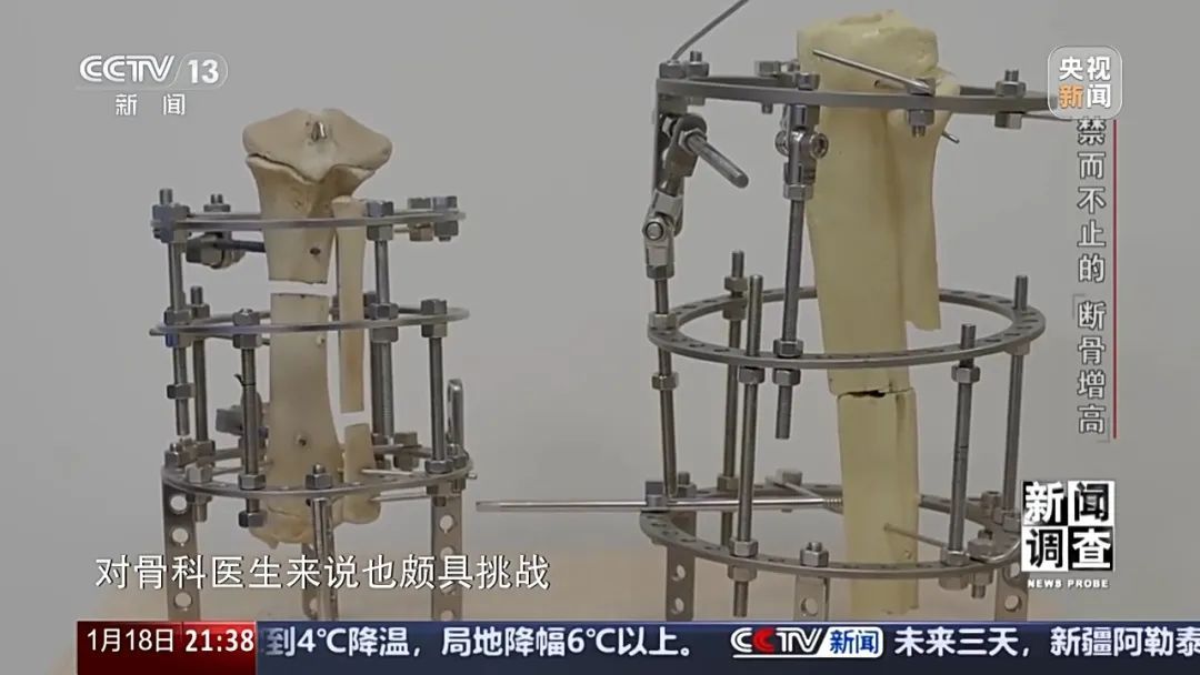 “腿喷脓了，挤也挤不完” ，女子出国做手术断骨增高6厘米，右腿严重感染