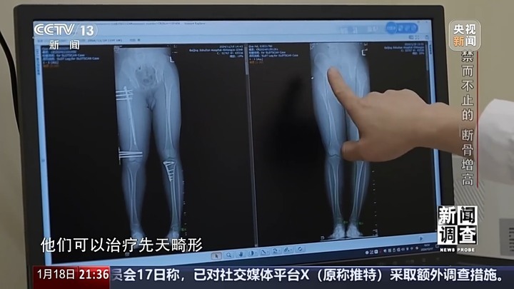 央视曝断骨增高灰色产业链 央视曝断骨增高灰色产业链