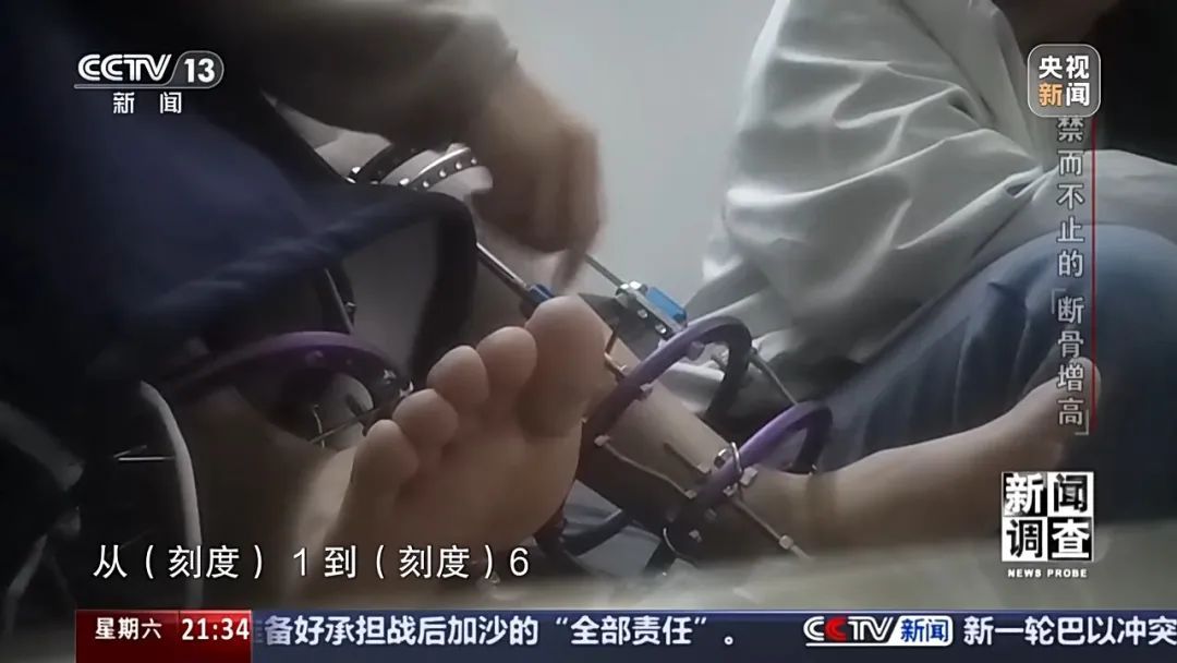 “腿喷脓了，挤也挤不完” ，女子出国做手术断骨增高6厘米，右腿严重感染