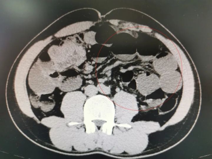 正大量上市！小伙“狂炫”两斤后进医院