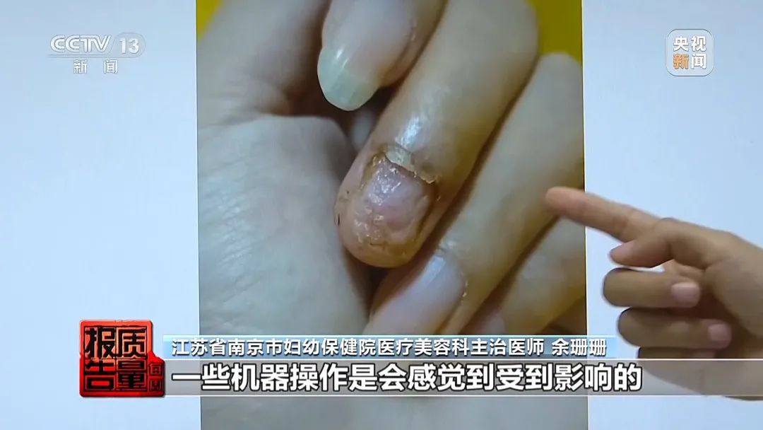女子美甲后指甲长出霉菌！原来美甲店还有这些隐患……