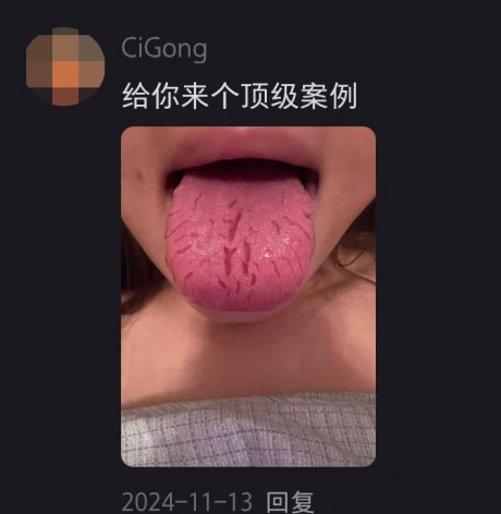 舌头上出现裂纹，是啥情况？