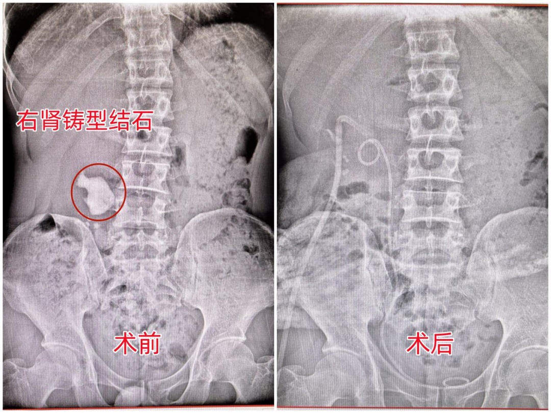 男子“狂炫”碳酸饮料及辛辣食物,结果…… 男子“狂炫”碳酸饮料及辛辣食物,结果……