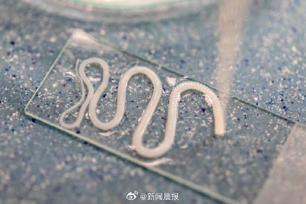 男子吃没熟猪肉下半身遍布绦虫卵，医生：见过最疯狂的X光片之一