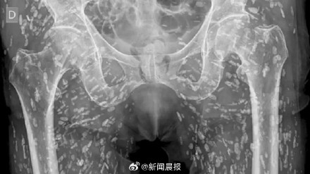 男子吃没熟猪肉下半身遍布绦虫卵，医生：见过最疯狂的X光片之一
