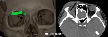 惊！女子眼眶扎入4.5厘米树枝竟不知