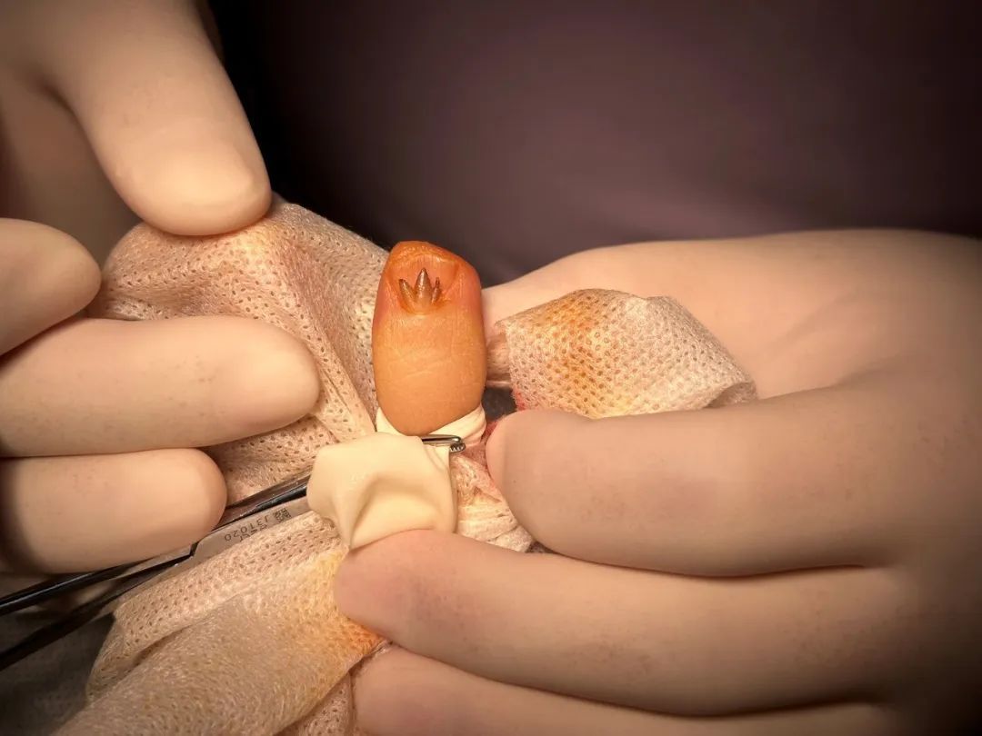 做美甲竟感染HPV，专家提醒