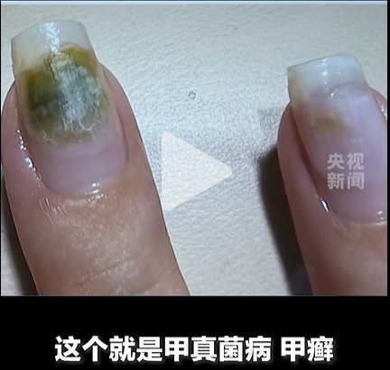 22岁女子感染HPV，只因......很多人也有这个爱好