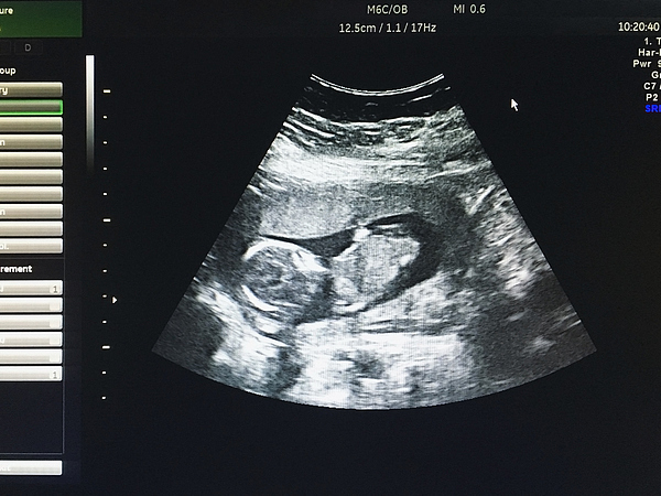 夫妻吵架致妻子胚停，医生盘点胚停原因