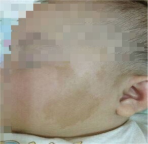 从小身上就有！以为是“胎记”，一查结果是肿瘤！