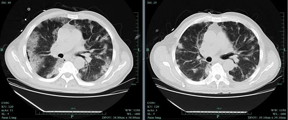 日本流感已超950万人！流感会致命吗？出现这些症状千万别拖→