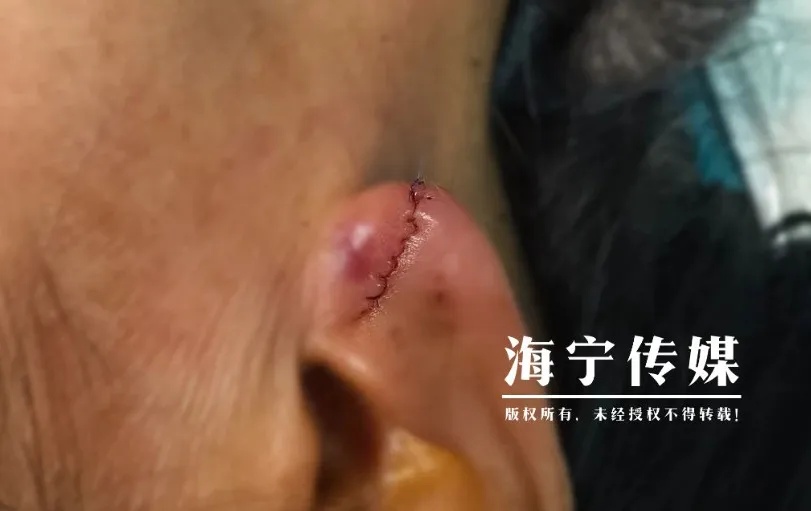 裂开！太疼了！浙江女子早上起床后，发现吓人一幕……