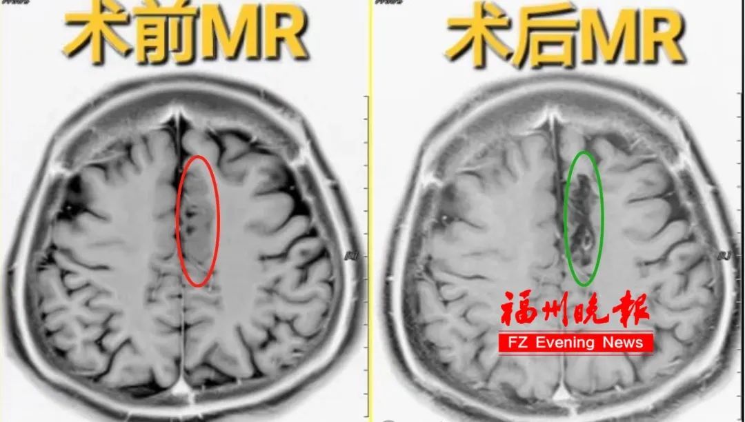 不是梦游！福州21岁女孩睡觉时拳打脚踢！一查竟是……