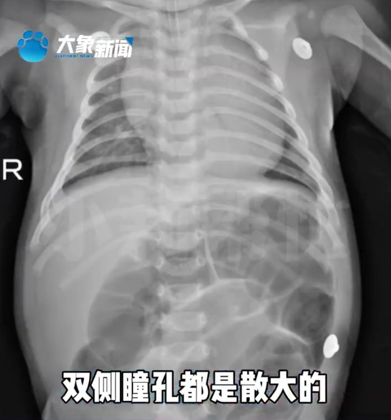 揪心！52天宝宝中毒被送ICU……医生提醒